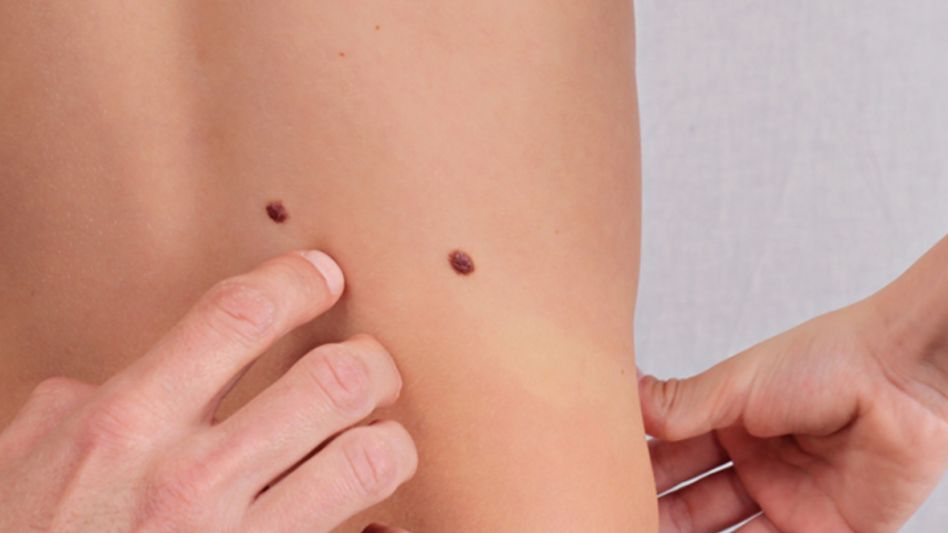 Melanoma: ¿qué debemos saber del tipo de cáncer de piel más agresivo?