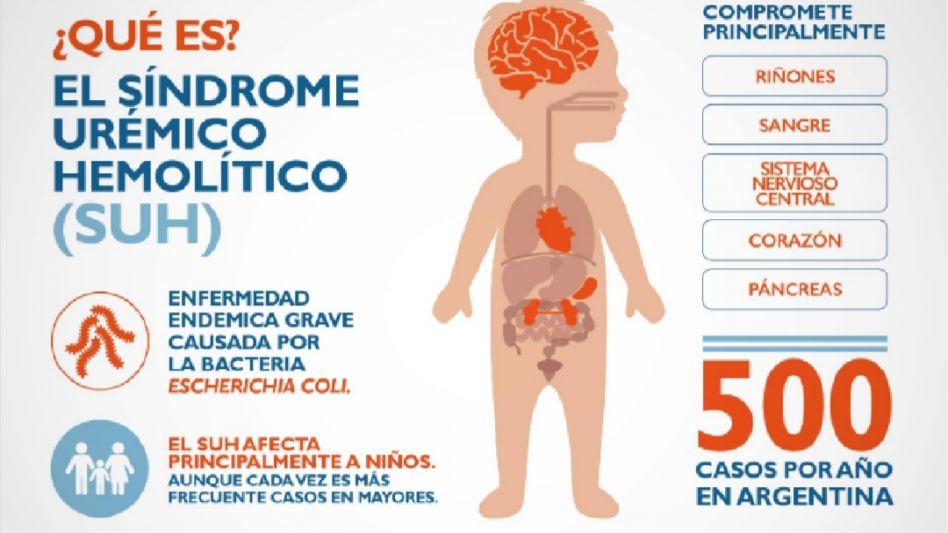 Una imagen de lo que es esta enfermedad que padece Ludmila.   ARCHIVO WEB  