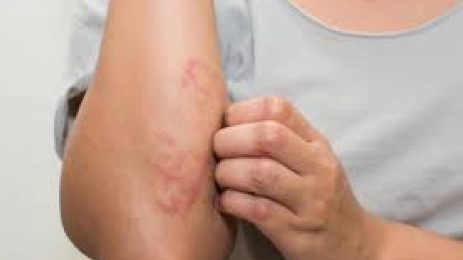 Hacia el control de la psoriasis: educación y nuevos tratamientos