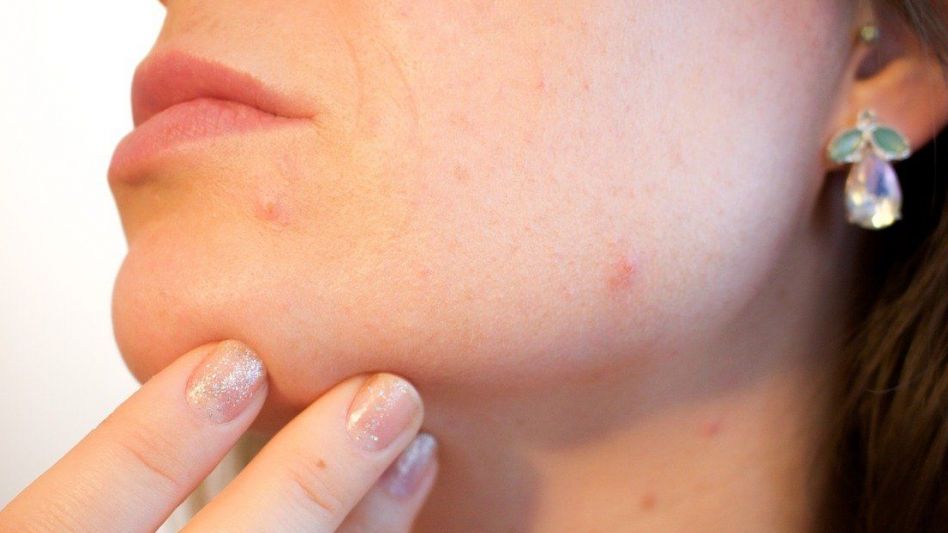 El acné tardío puede indicar trastornos hormonales