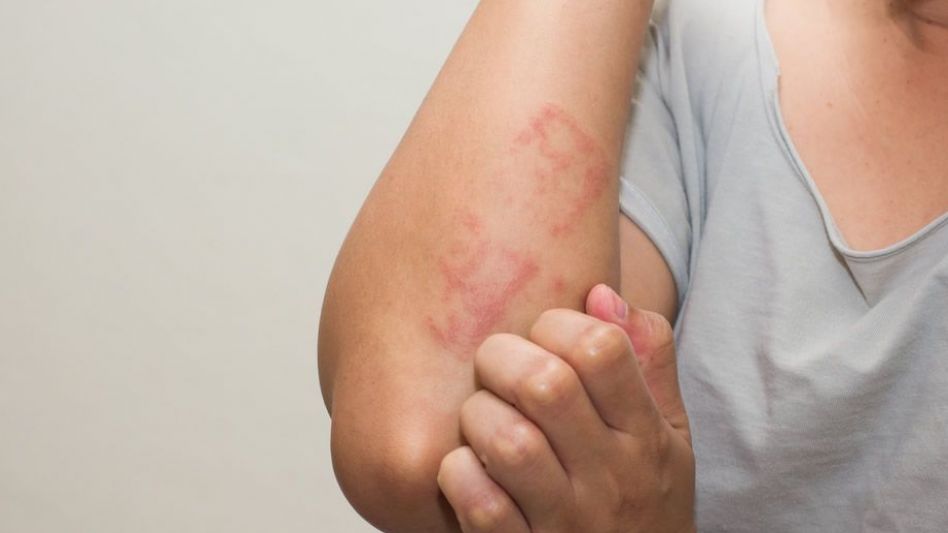 Dermatitis atópica, una enfermedad que no solo afecta a la piel