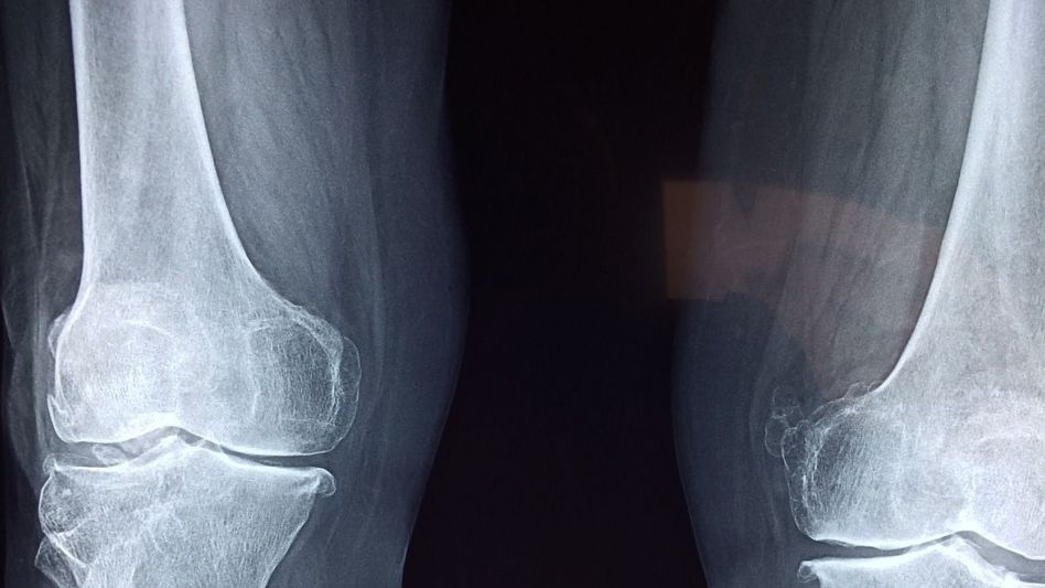 Osteoporosis: En Argentina se producen 90 fracturas de cadera por día