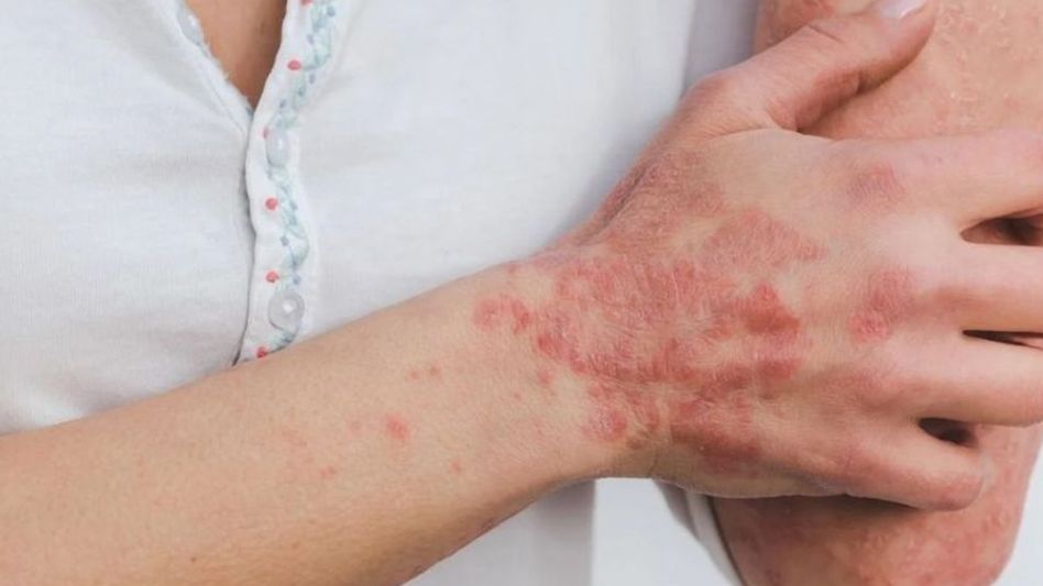 Psoriasis: la importancia de diagnosticar y tratar a tiempo