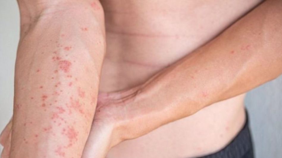 Adolescentes: el impacto de la dermatitis atópica en los meses de calor