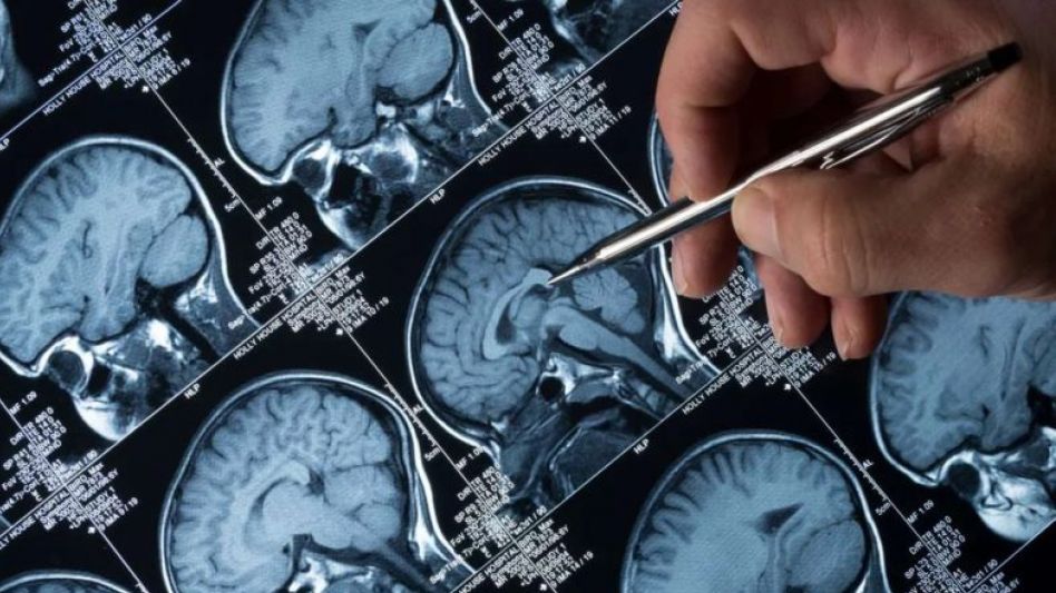 La enfermedad de Alzheimer puede aumentar el riesgo de Covid grave