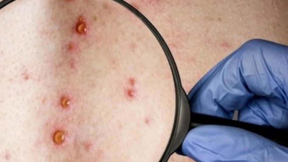 Salud alertó por un caso sospechoso de viruela del mono en el país