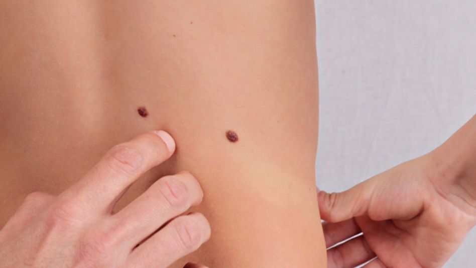 Controlar lunares y cuidarse del sol, las claves para prevenir el melanoma