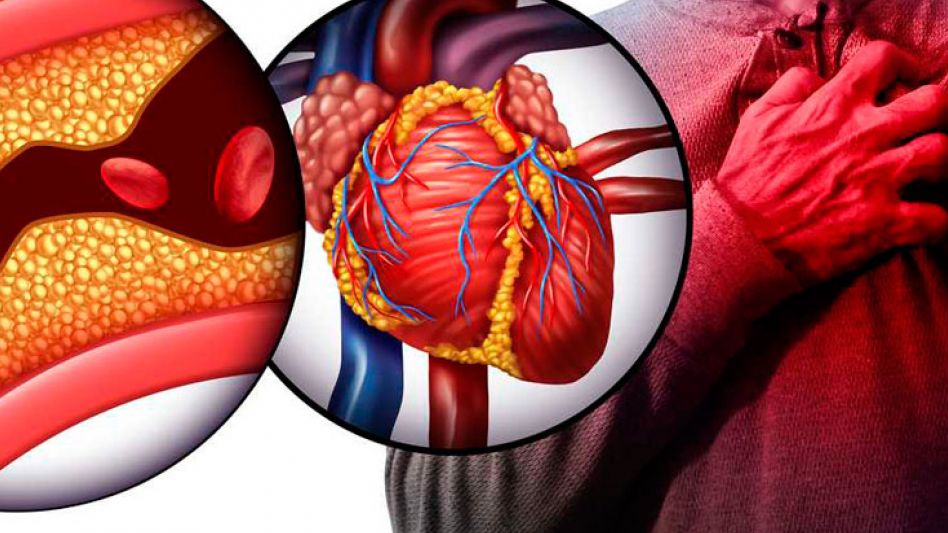 Riesgo cardiovascular y colesterol: buscan reducir en un 30% mortalidad por infarto 