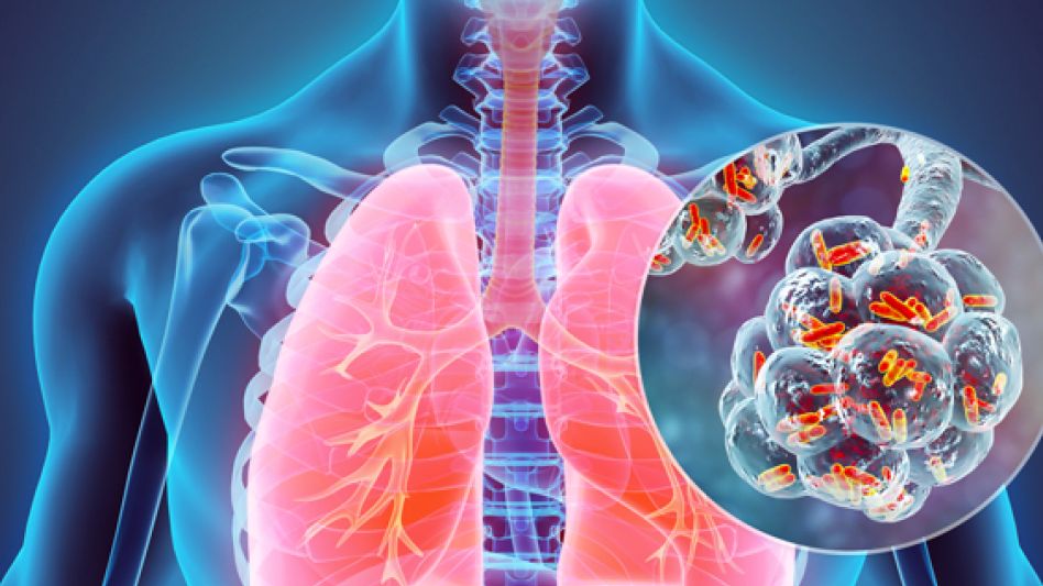 El brote de Legionella   