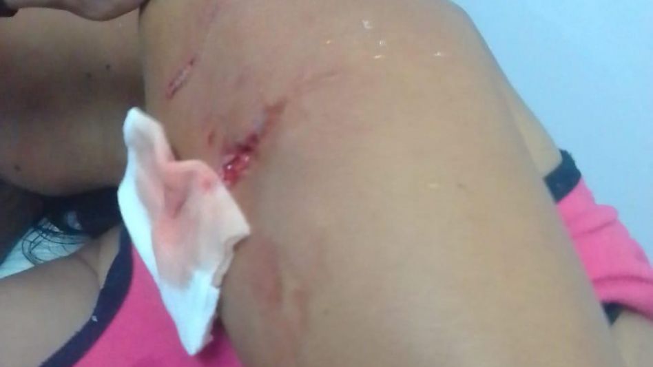 Como consecuencia del ataque, Mirian Rojo tuvo que ser cosida por personal del Hospital Pintos. Le dieron diez puntos de sutura en su brazo izquierdo. GENTILEZA/MIRIAN ROJO