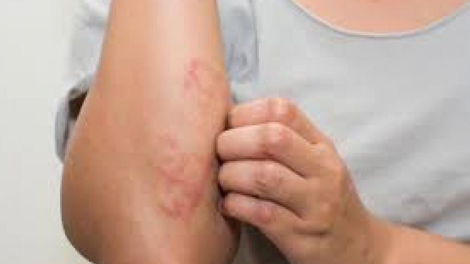 Psoriasis: al menos el 20% de los pacientes necesita ayuda psicológica
