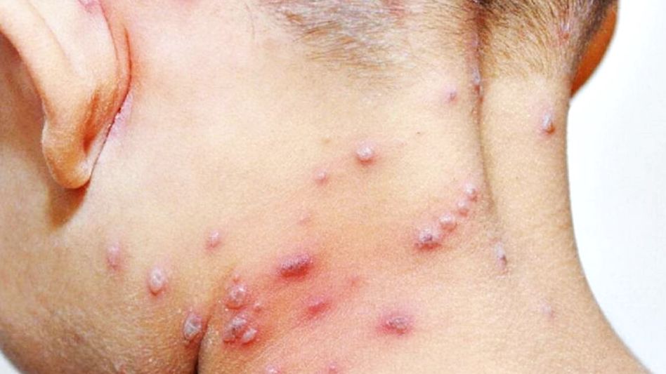 Confirman la segunda muerte en el país por viruela símica