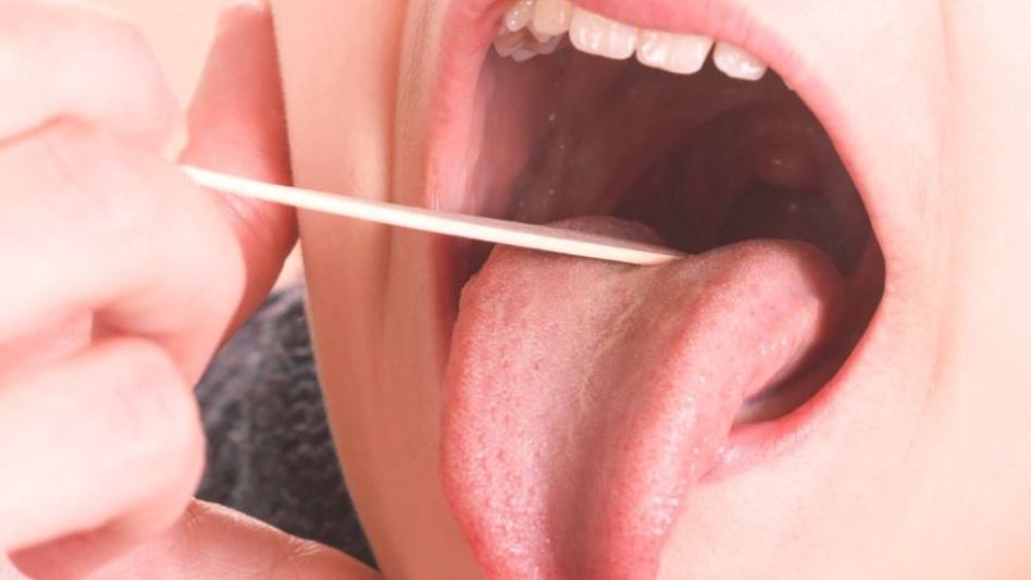 Alerta ante el aumento de casos de angina con placas por Streptococcus pyogenes