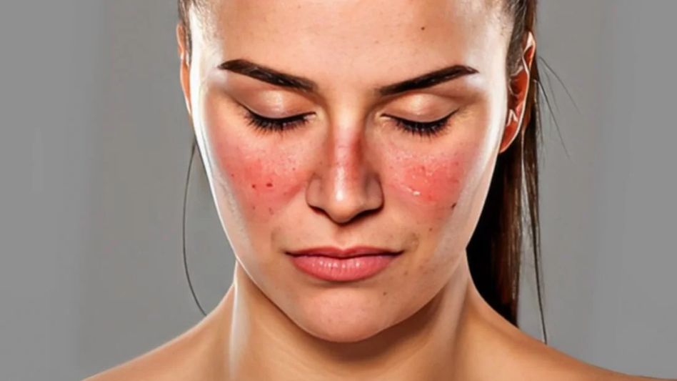 Lupus: qué es y cómo afecta la calidad de vida