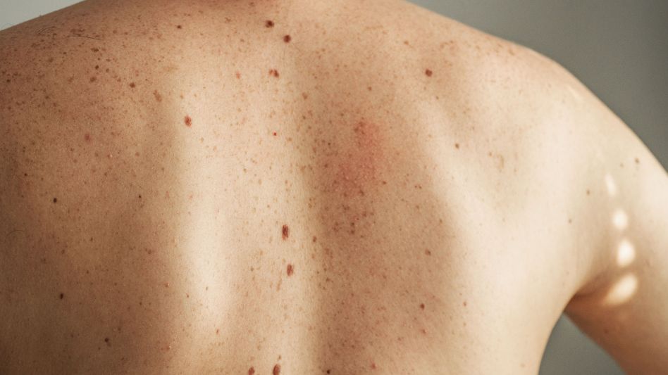 Melanoma: cómo prevenir el cáncer de piel más agresivo