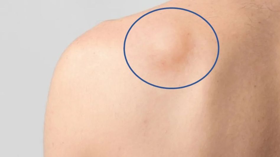 Cinco preguntas y respuestas: ¿Qué sabemos del sarcoma?