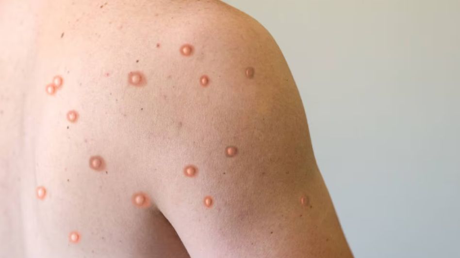 Mpox o viruela símica: hay ocho casos detectados en Argentina y se profundiza la vigilancia