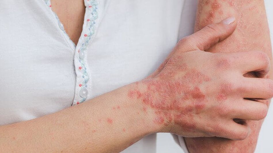 Psoriasis: 4 de cada 10 pacientes suspenden consultas por motivos económicos