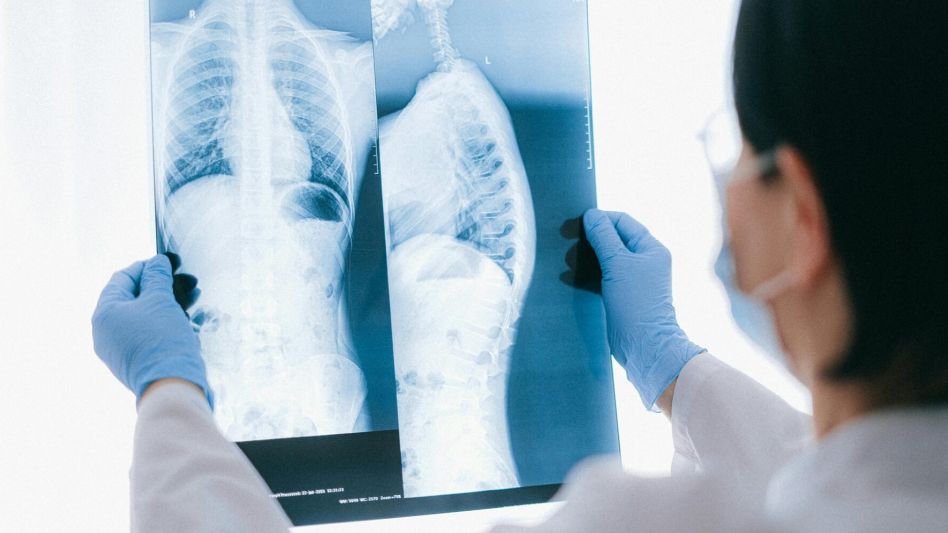 ¿Cómo avanza la medicina de precisión para tratar el cáncer de pulmón?