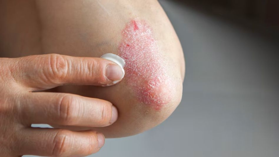 Psoriasis: un mal incurable pero que se sobrelleva con tratamiento y buenos hábitos