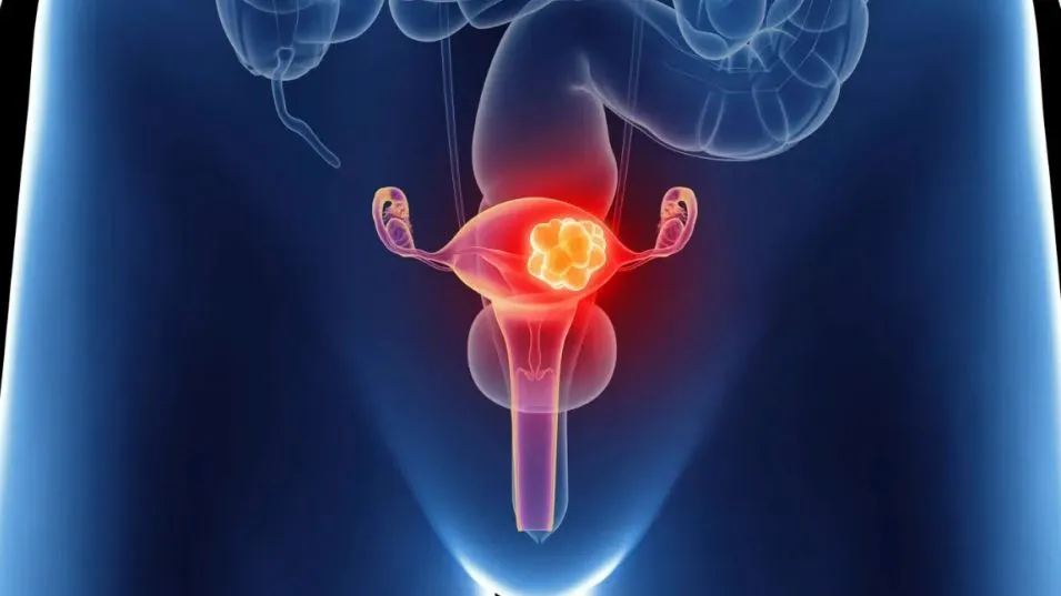 Cáncer ovárico: siete de cada diez mujeres llegan tarde al diagnóstico