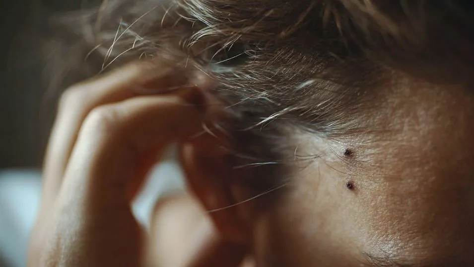 #AlianzaMelaNOmás: los peluqueros se suman a la campaña para concientizar sobre el melanoma
