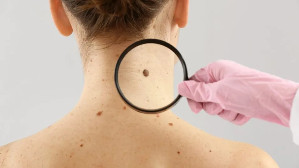 Cáncer de Piel: autoexamen, detección precoz y cuidado para evitar complicaciones