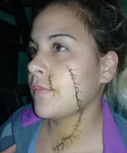 Desfiguraron el rostro de una joven  que fue víctima de un brutal ataque