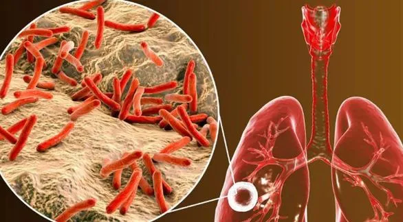 Aumentaron un 38% los casos de tuberculosis en Argentina