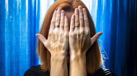 Vitiligo: una condición de la piel con impacto emocional 