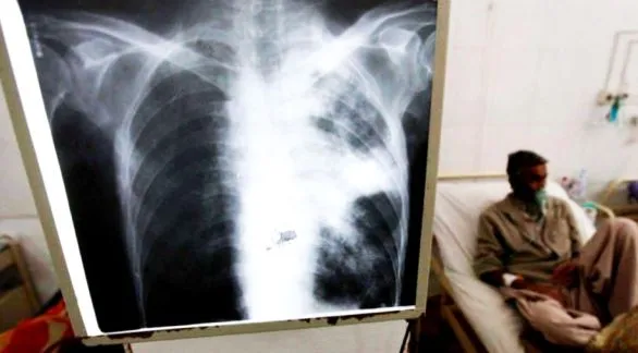 Tuberculosis: entre 2020 y lo que va de 2025 los casos aumentaron un 65%
