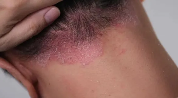 La dermatitis atópica: cuando la picazón persistente impacta en la calidad de vida